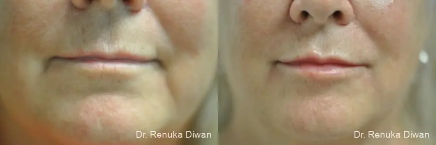 Lip Augmentation: Patient 15 - Before and After 1