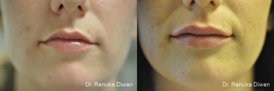 Lip Augmentation: Patient 2 - Before and After  