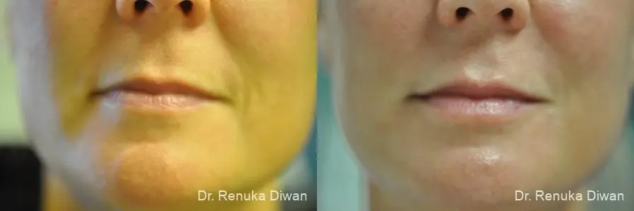 Lip Augmentation: Patient 11 - Before and After 1