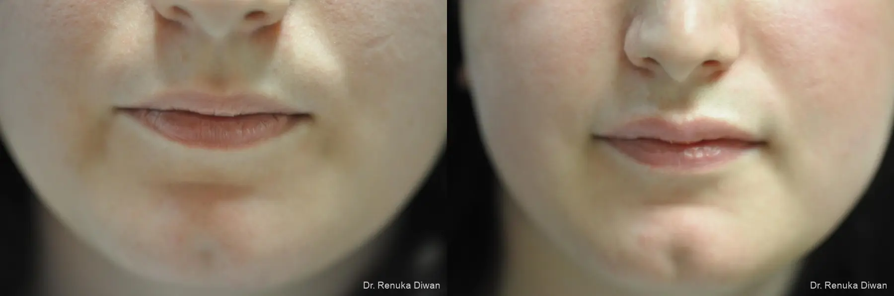 Lip Augmentation: Patient 21 - Before and After 1