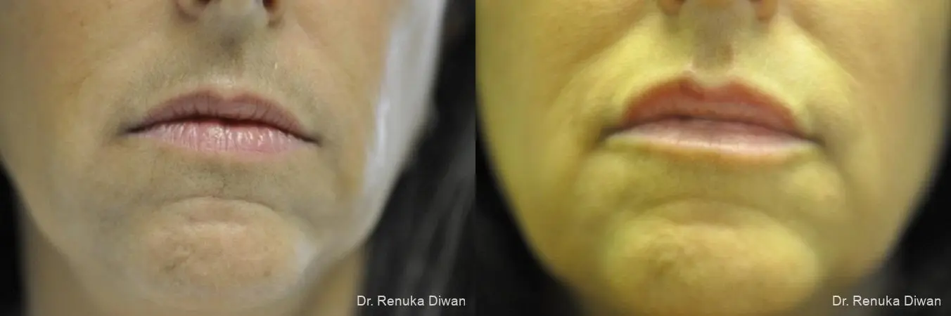 Lip Augmentation: Patient 6 - Before and After 1