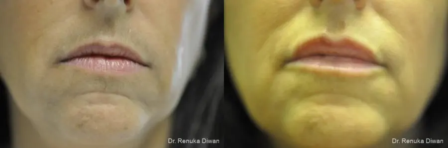 Lip Augmentation: Patient 6 - Before and After  