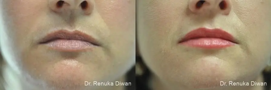 Lip Augmentation: Patient 8 - Before and After  
