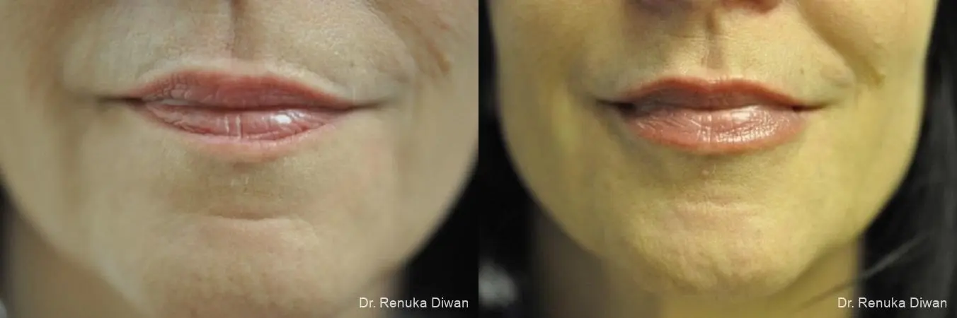 Lip Augmentation: Patient 3 - Before and After  