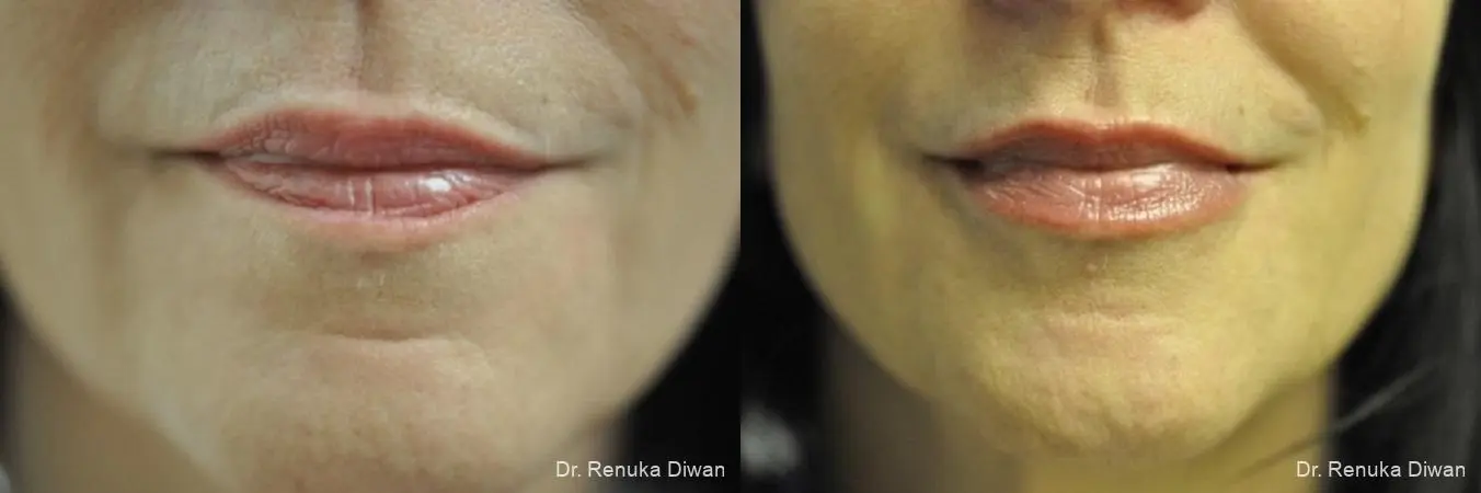 Lip Augmentation: Patient 3 - Before and After 1