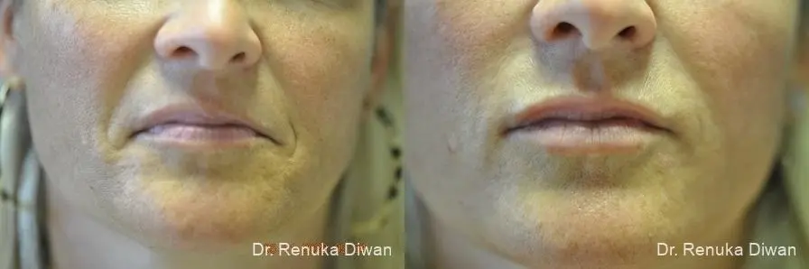 Lip Augmentation: Patient 12 - Before and After 1