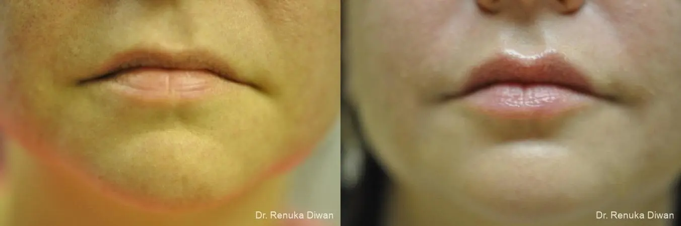 Lip Augmentation: Patient 4 - Before and After 1