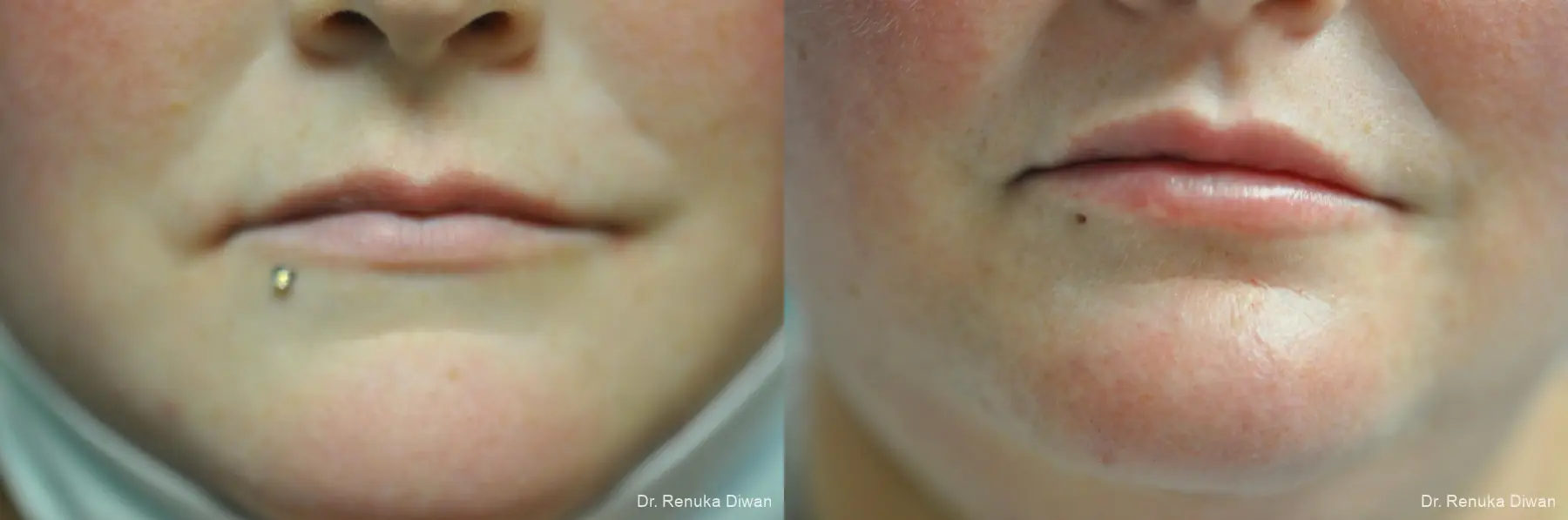 Lip Augmentation: Patient 19 - Before and After 1