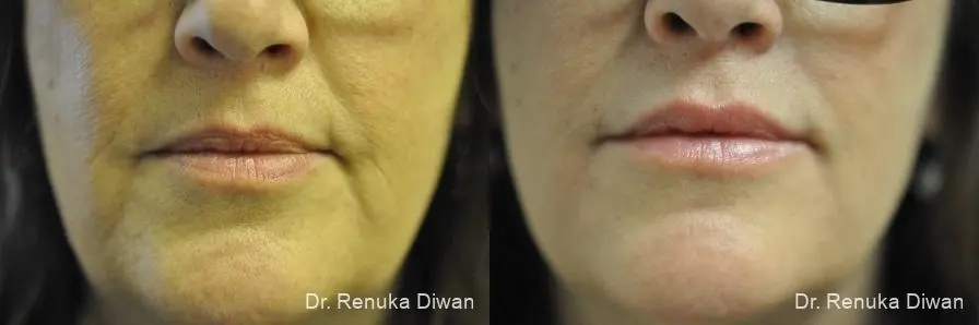 Lip Augmentation: Patient 10 - Before and After  