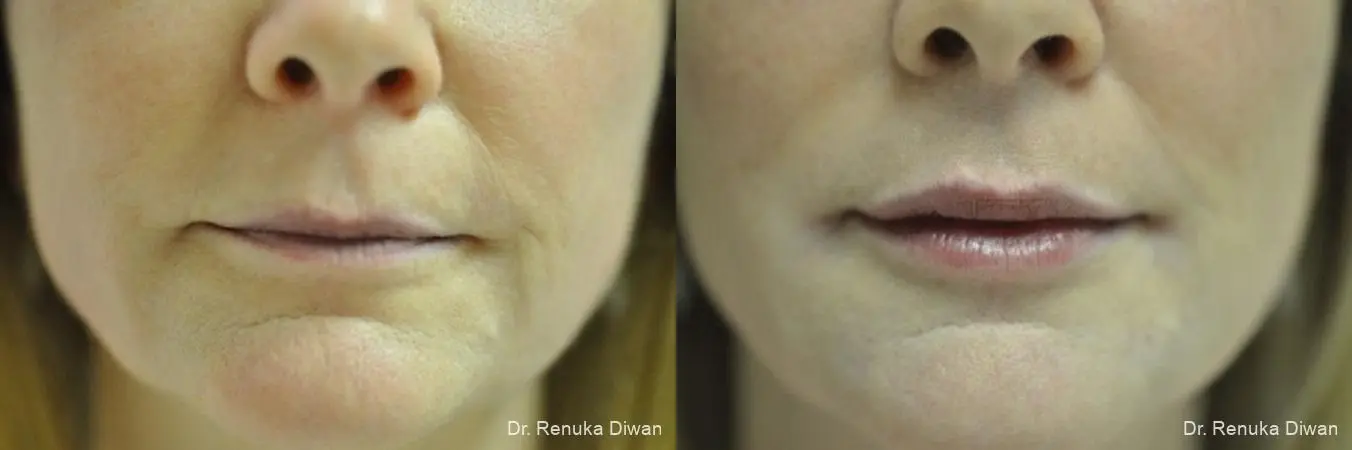 Lip Augmentation: Patient 5 - Before and After  