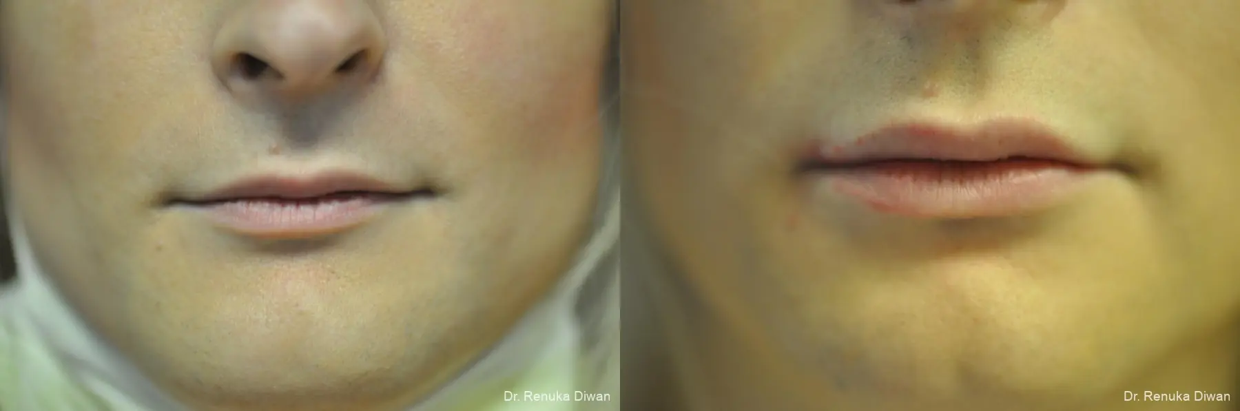 Lip Augmentation: Patient 18 - Before and After 1