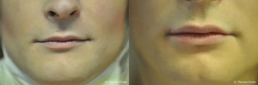 Lip Augmentation: Patient 18 - Before and After 1