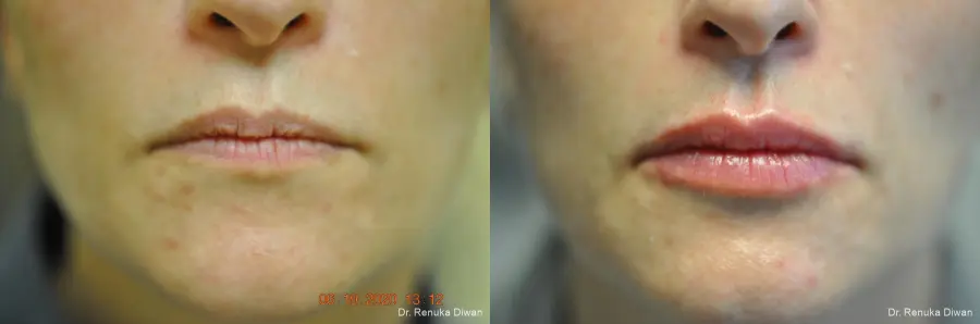Lip Augmentation: Patient 13 - Before and After 1