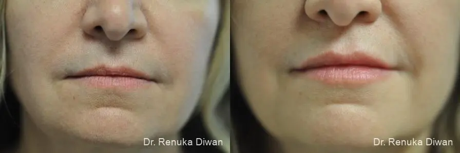 Lip Augmentation: Patient 9 - Before and After 1