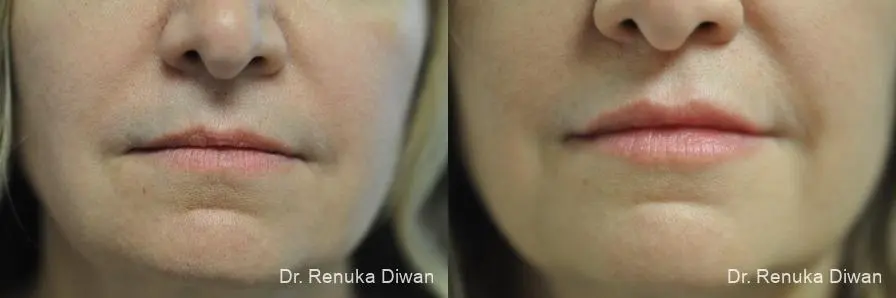 Lip Augmentation: Patient 9 - Before and After  