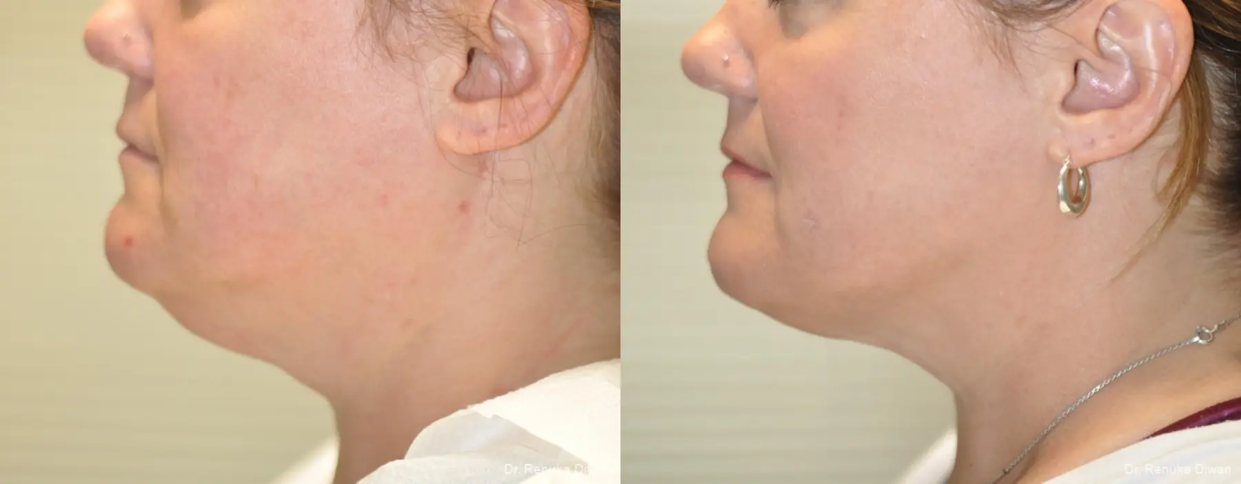 Liposuction: Patient 22 - Before and After 2