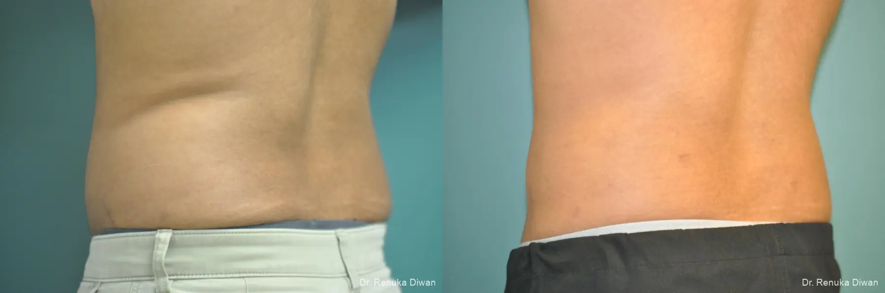 Liposuction: Patient 20 - Before and After 1