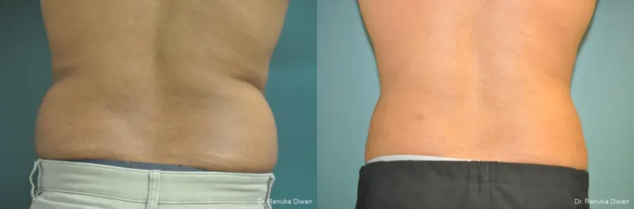 Liposuction-for-men: Patient 1 - Before and After  