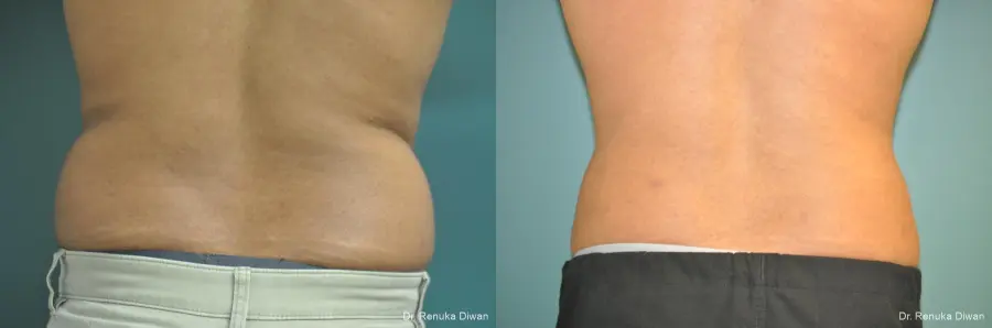 Liposuction-for-men: Patient 1 - Before and After