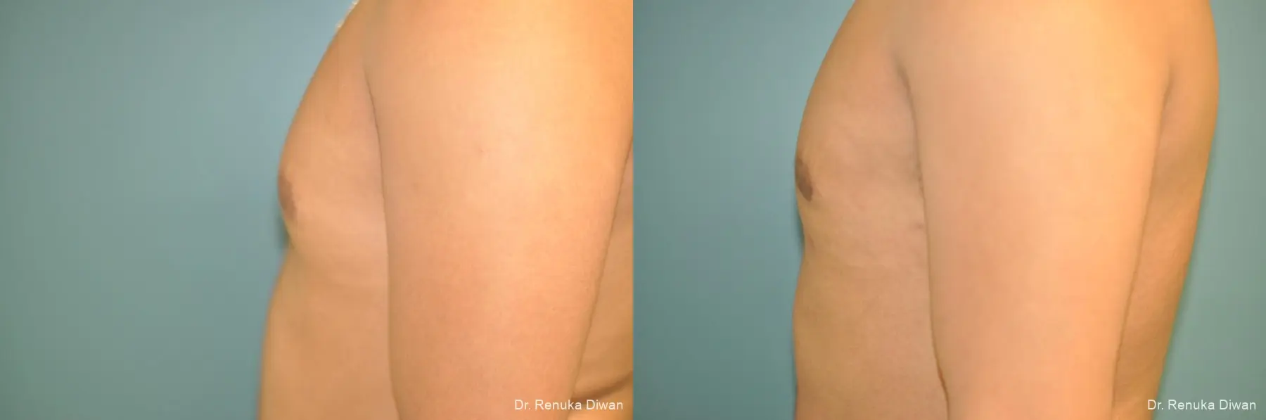 Liposuction-for-men: Patient 2 - Before and After  
