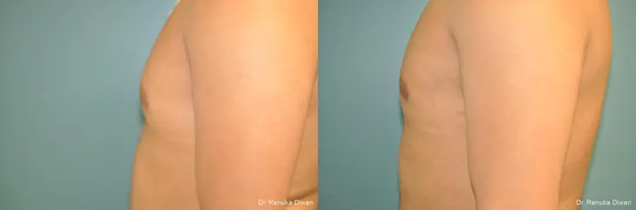 Liposuction-for-men: Patient 2 - Before and After