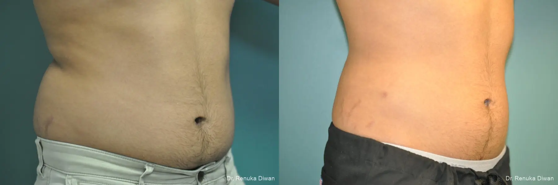 Liposuction For Men: Patient 1 - Before and After 3