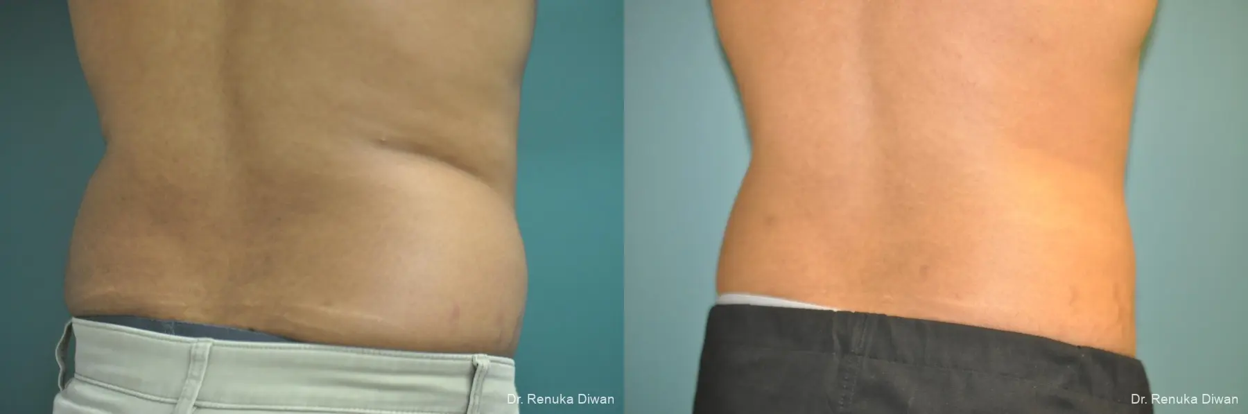 Liposuction For Men: Patient 1 - Before and After 2