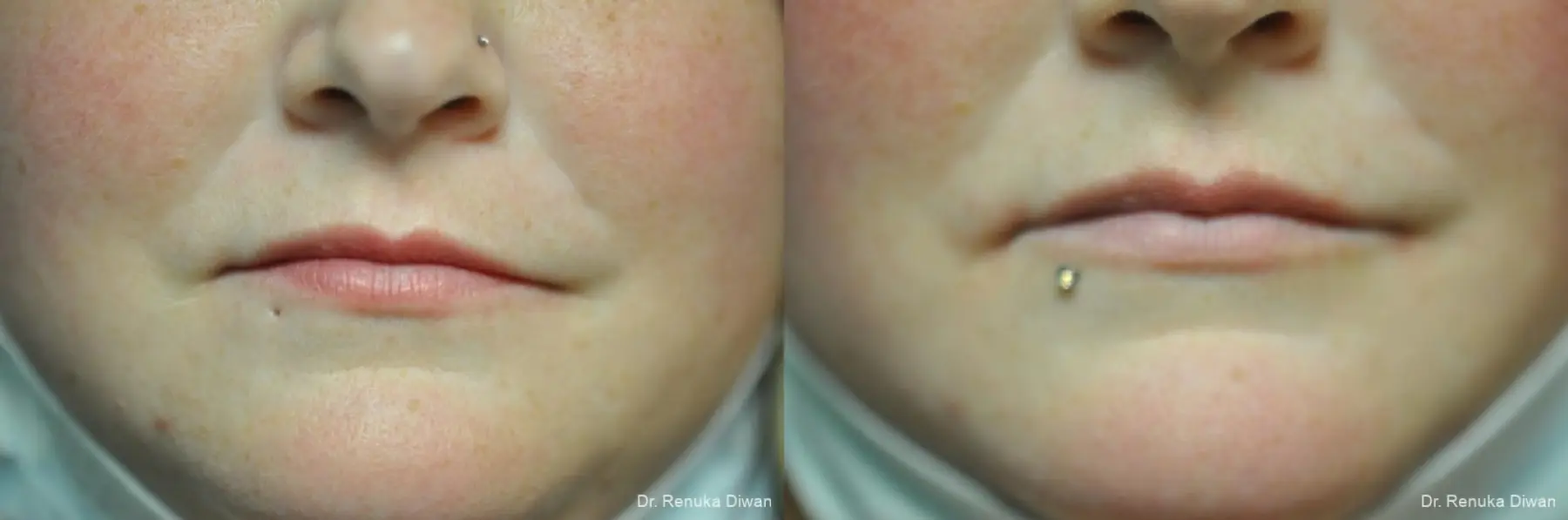 Lips And Mouth: Patient 19 - Before and After 1