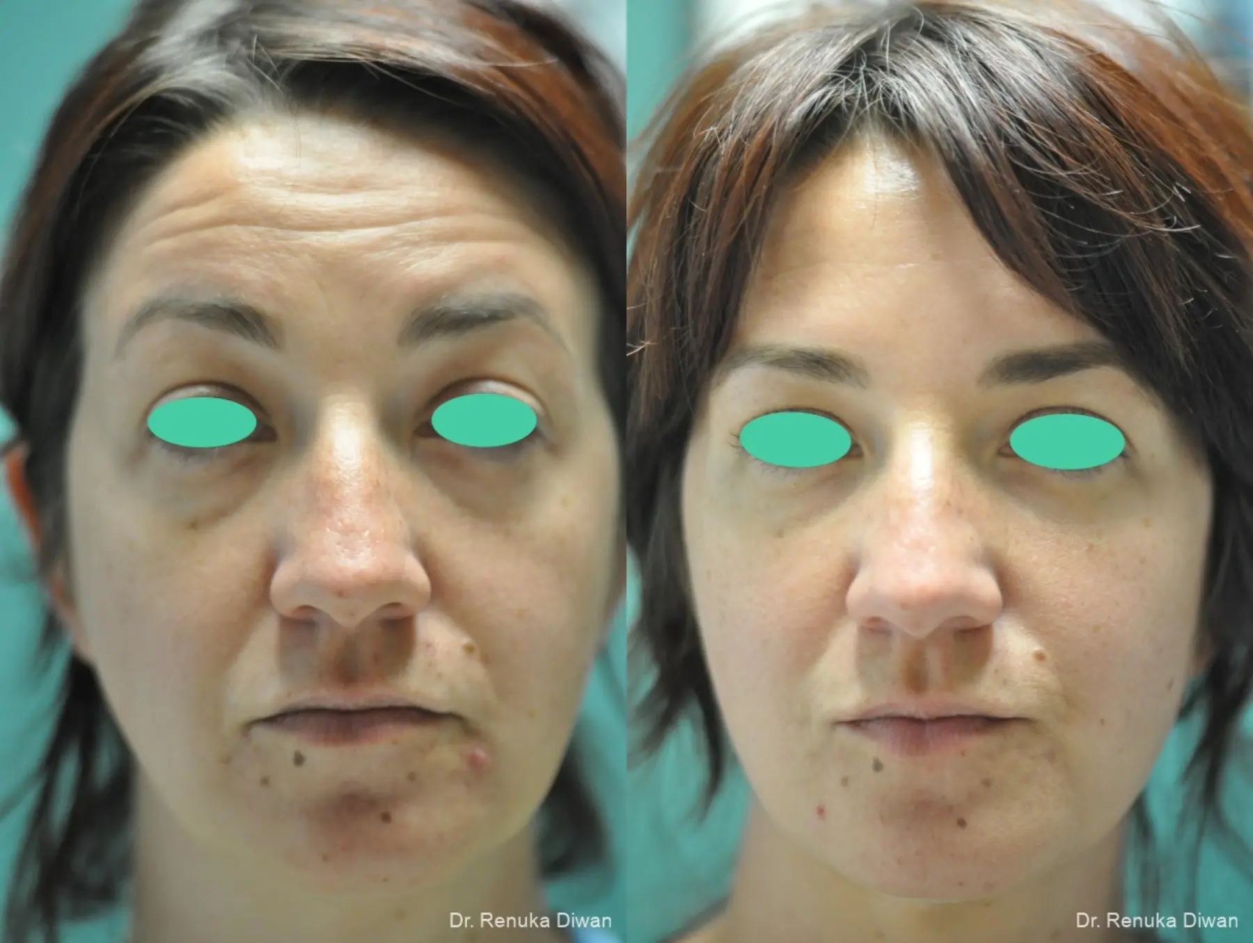 Loss Of Fullness: Patient 15 - Before and After 1