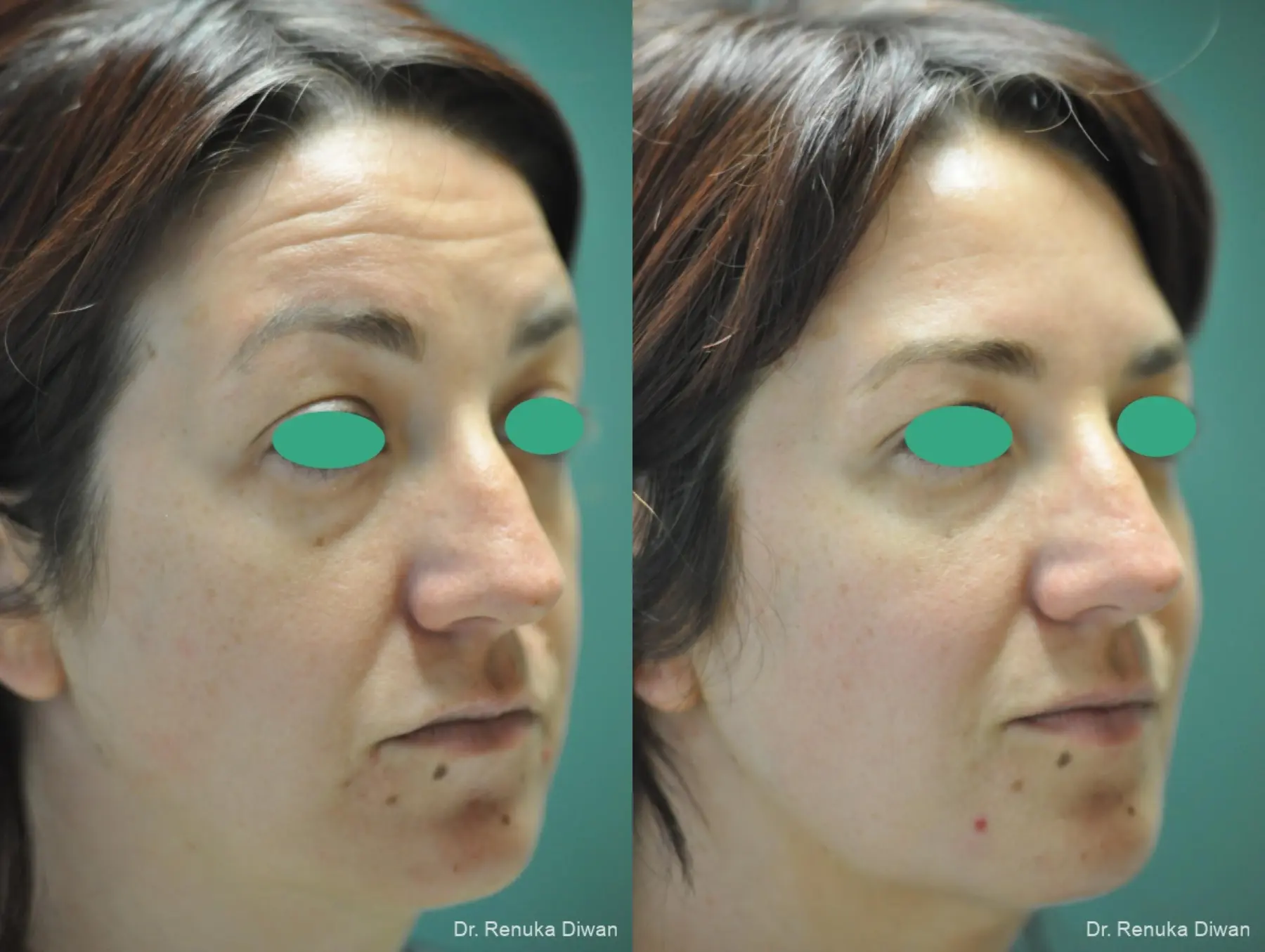 Loss Of Fullness: Patient 15 - Before and After 3