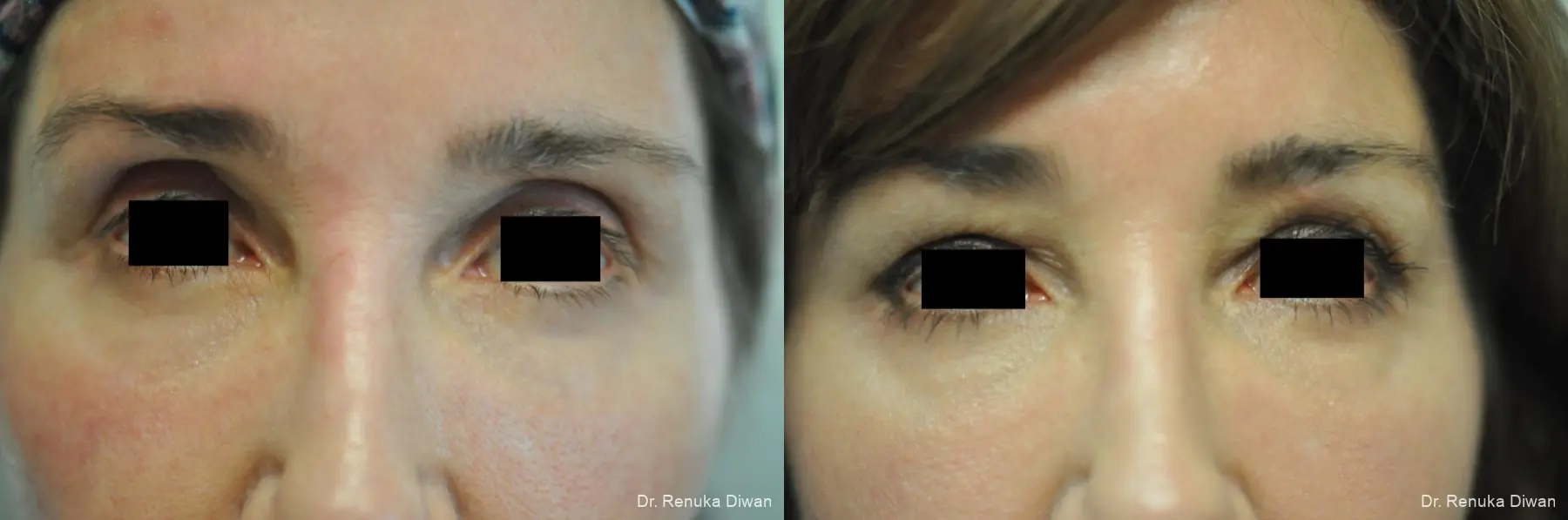 Loss Of Fullness: Patient 14 - Before and After 1