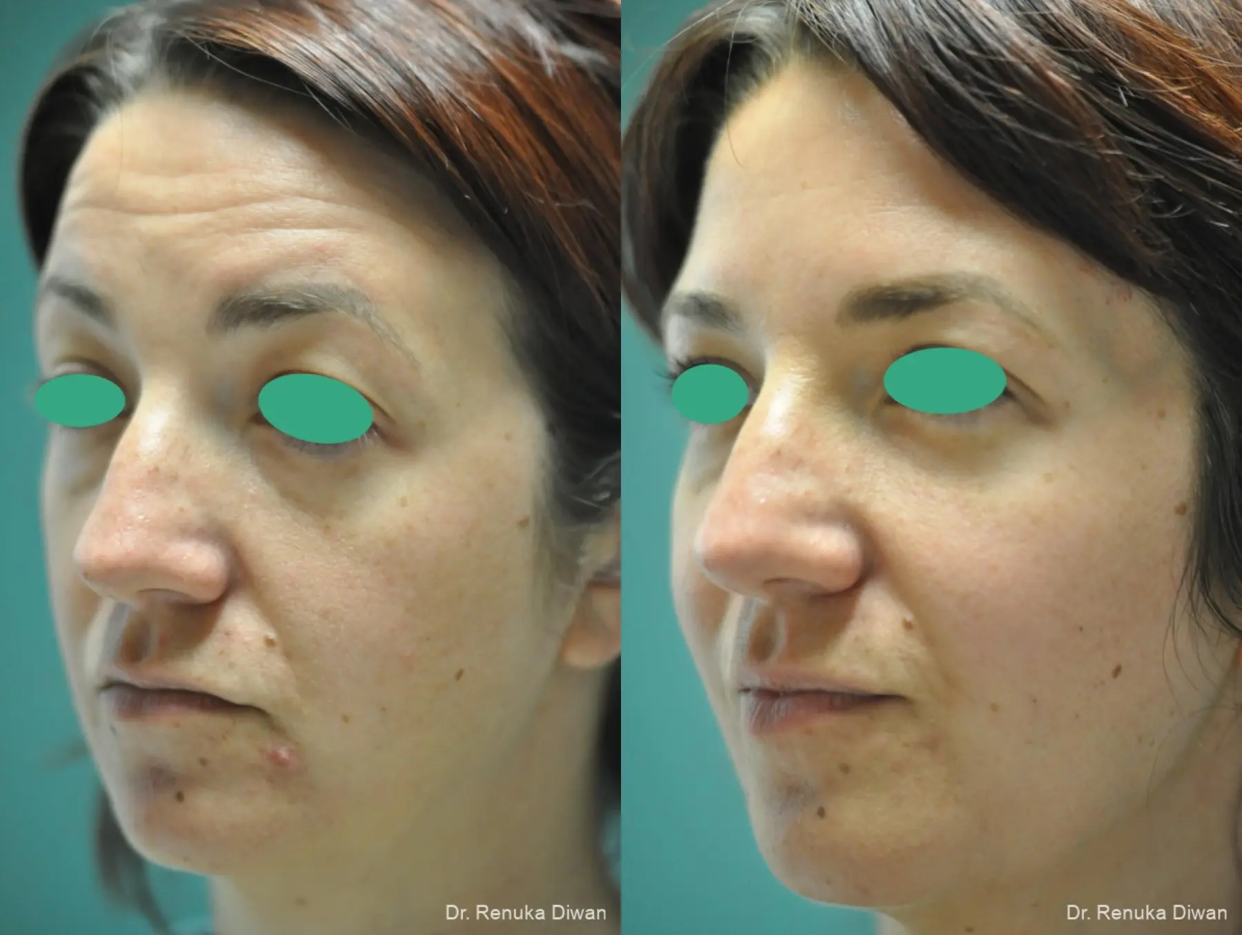 Loss Of Fullness: Patient 15 - Before and After 2