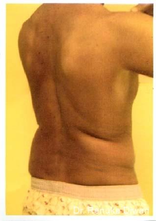 Liposuction: Patient 6 - Before 