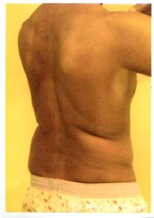 Liposuction: Patient 6 - Before 