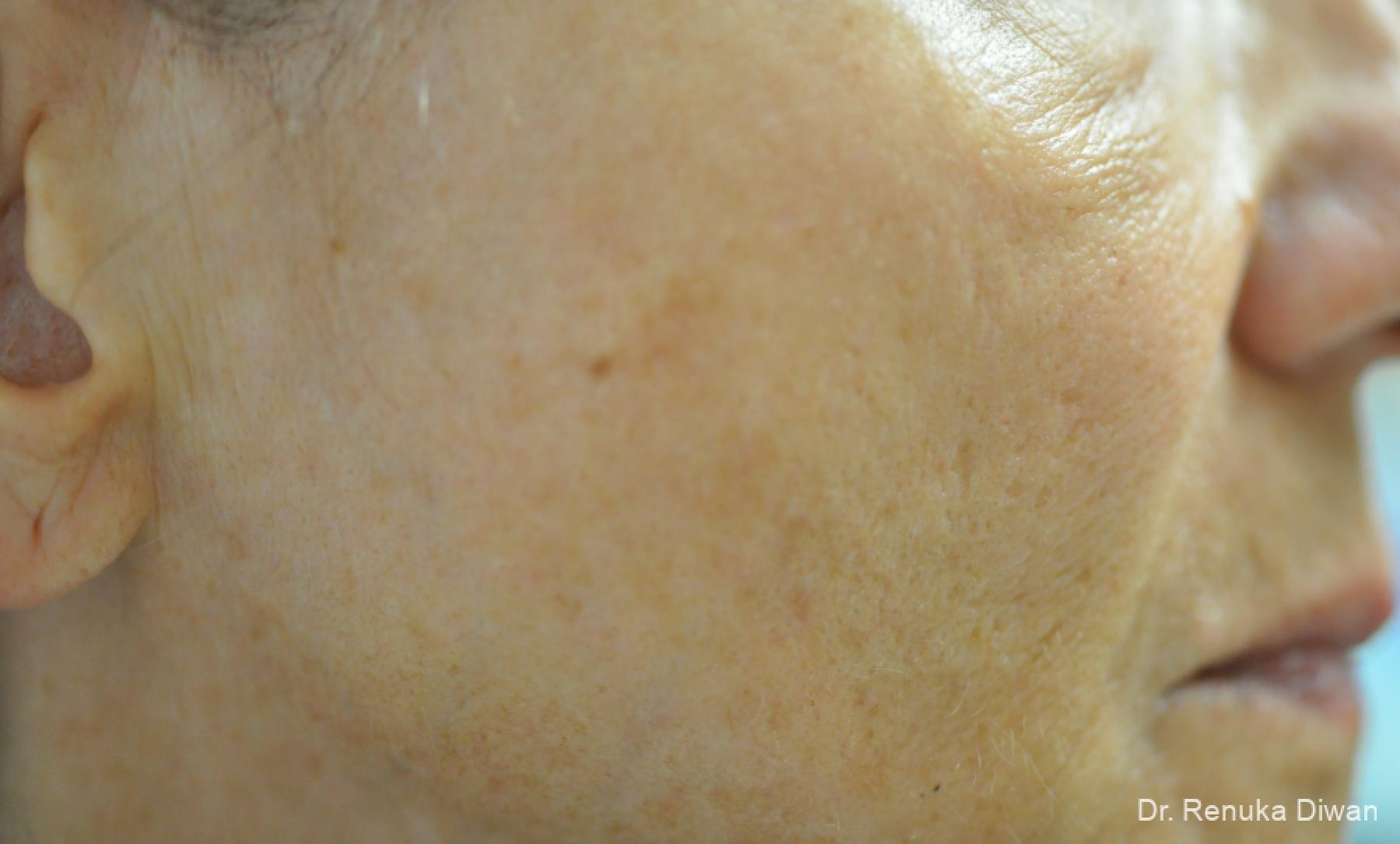 Lasers For Brown Spots: Patient 15 - After 1