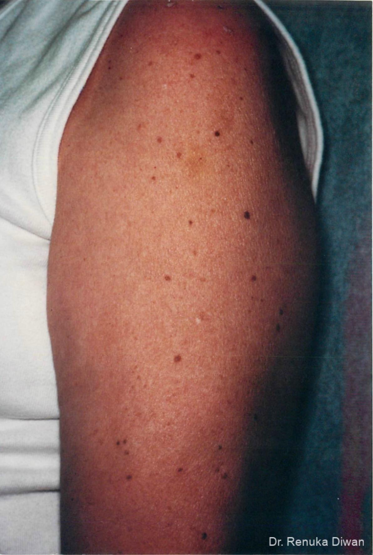 Lasers For Brown Spots: Patient 4 - Before 1