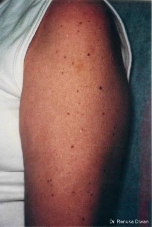 Lasers For Brown Spots: Patient 4 - Before 