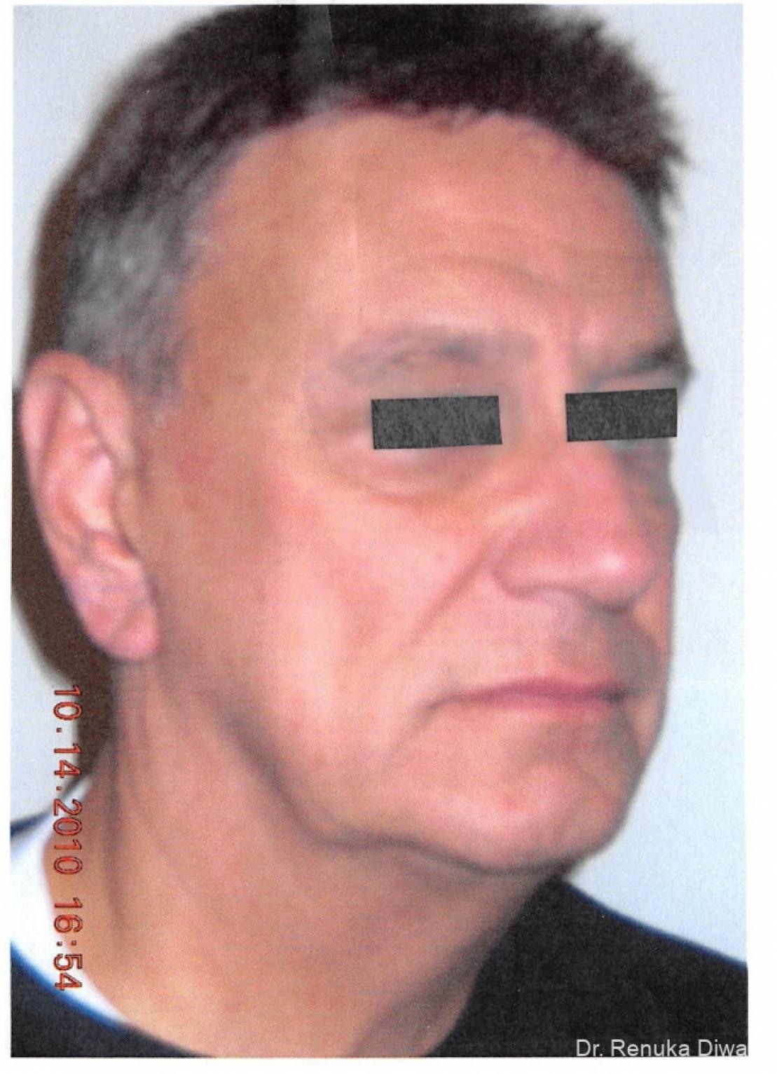 Facelift-for-men: Patient 1 - Before 