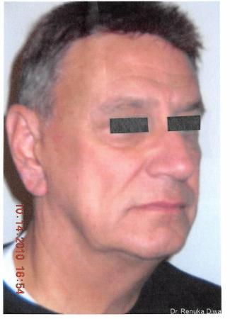 Facelift--neck-lift-for-men: Patient 1 - Before Image