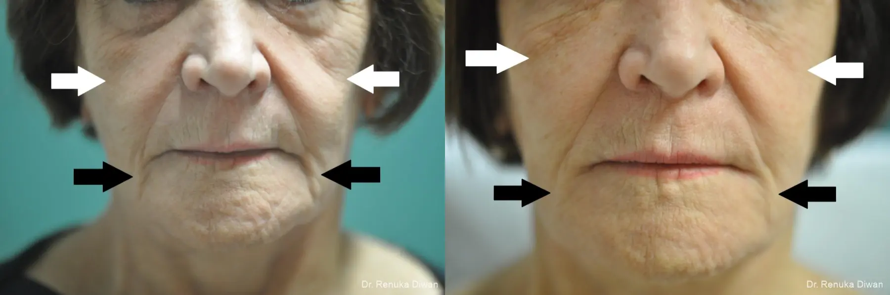 Marionette Lines: Patient 2 - Before and After  