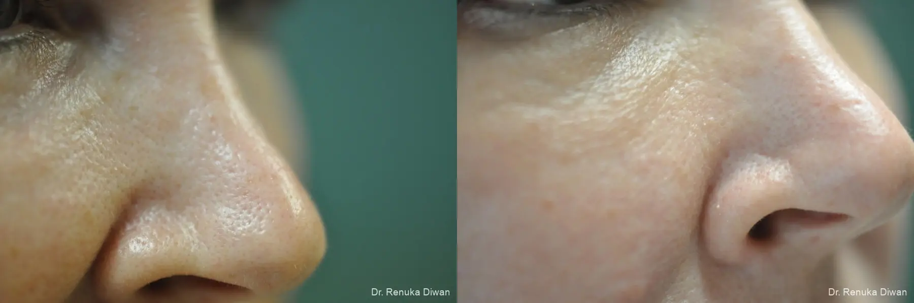 Microneedling: Patient 6 - Before and After  
