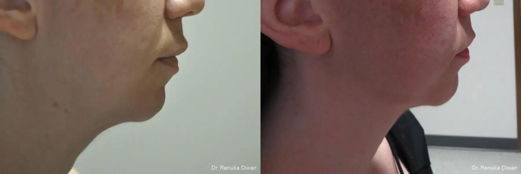 Microneedling: Patient 9 - Before and After  