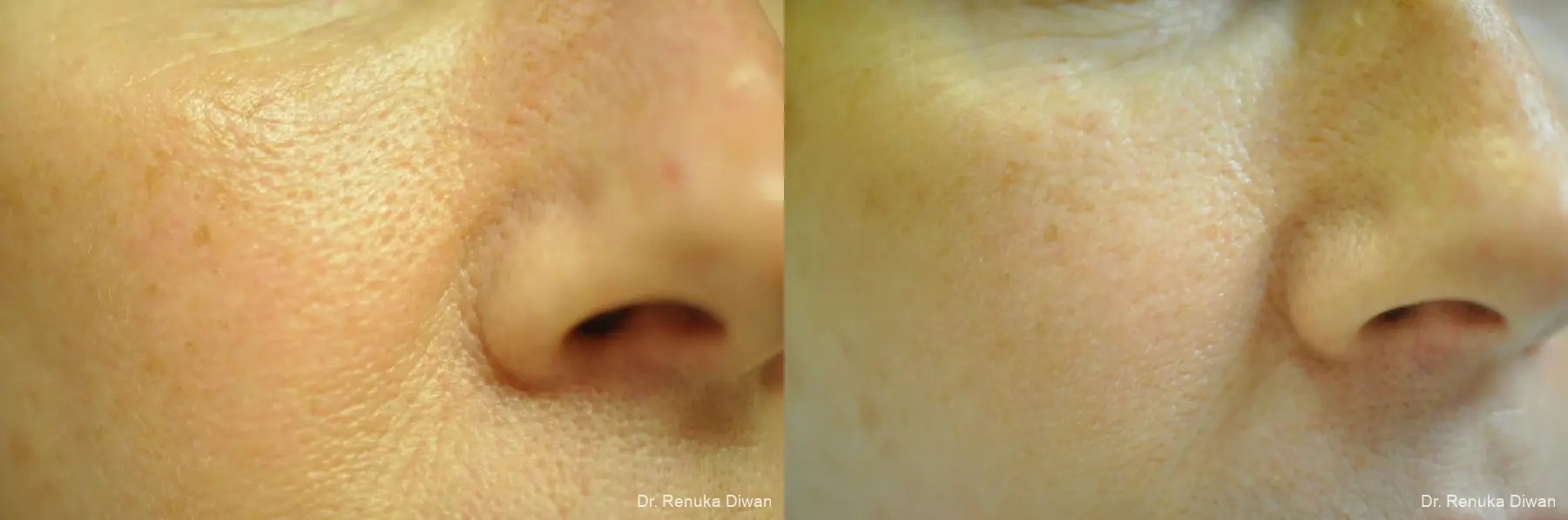 Microneedling: Patient 5 - Before and After  