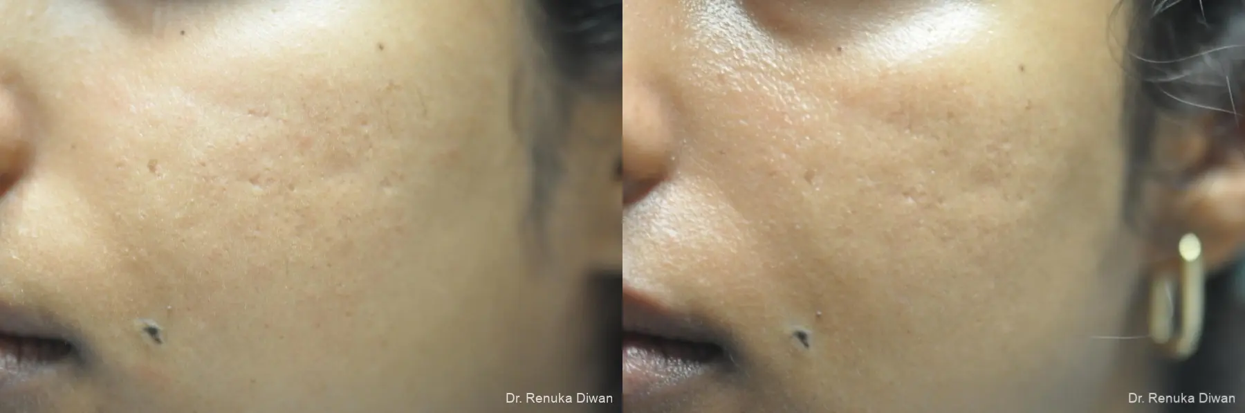 Microneedling: Patient 1 - Before and After 1