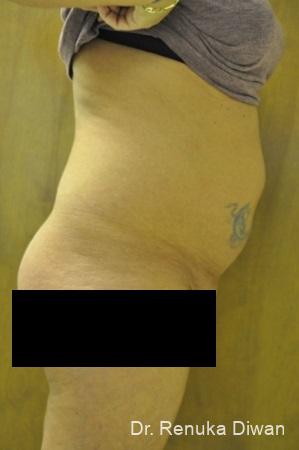 Liposuction: Patient 14 - Before 1