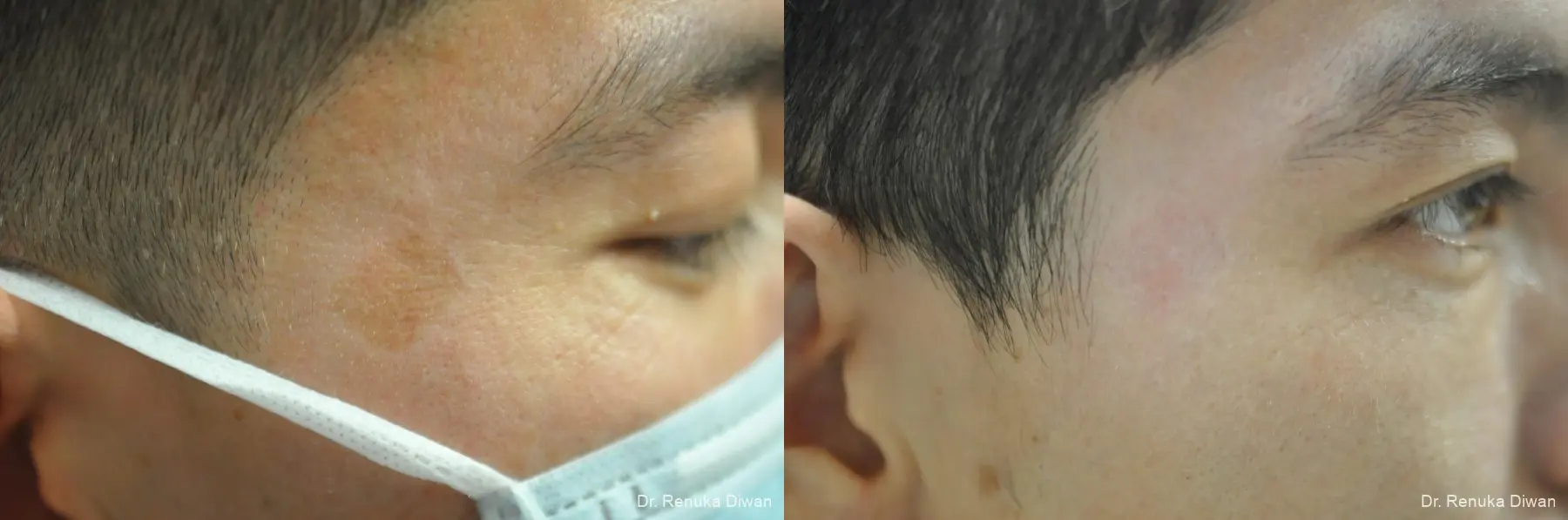 Mole-removal-for-men: Patient 1 - Before and After  