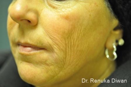 Laser Skin Resurfacing: Patient 1 - Before 