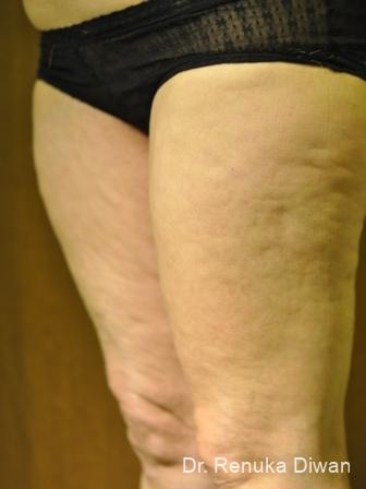 Cellulite Reduction: Patient 1 - Before 1