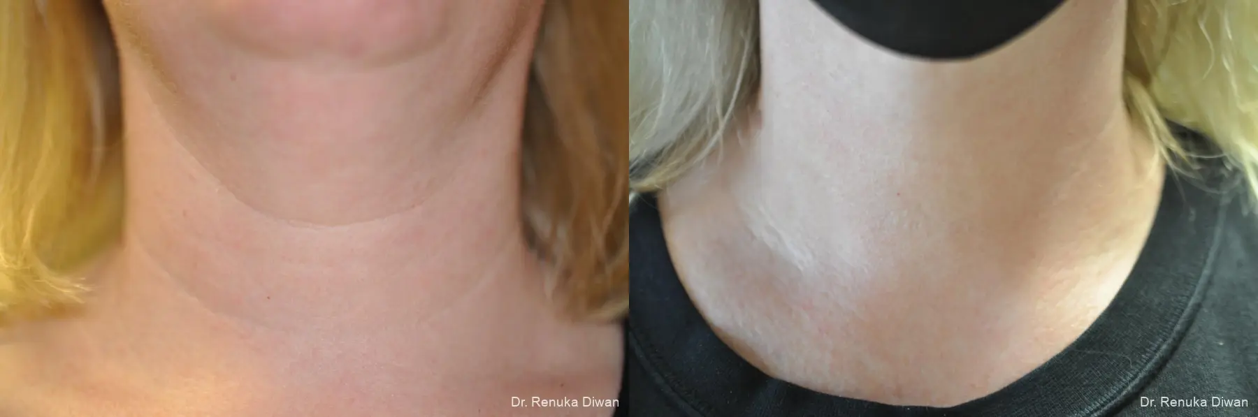 Neck Creases: Patient 5 - Before and After  