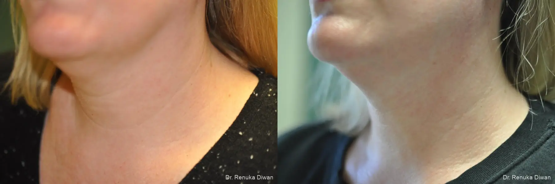 Neck Creases: Patient 5 - Before and After 3
